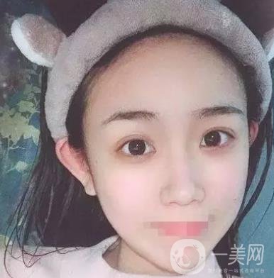 重慶醫(yī)科大學(xué)附屬第一醫(yī)院整形科價格價目表，附雙眼皮*果圖