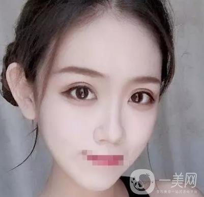 重慶醫(yī)科大學(xué)附屬第一醫(yī)院整形科價格價目表，附雙眼皮*果圖