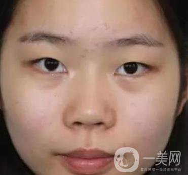 淮安第一人民醫(yī)院割雙眼皮怎樣?真人案例及整形價(jià)格表分享
