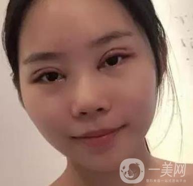 淮安第一人民醫(yī)院割雙眼皮怎樣?真人案例及整形價(jià)格表分享