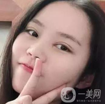 淮安第一人民醫(yī)院割雙眼皮怎樣?真人案例及整形價(jià)格表分享