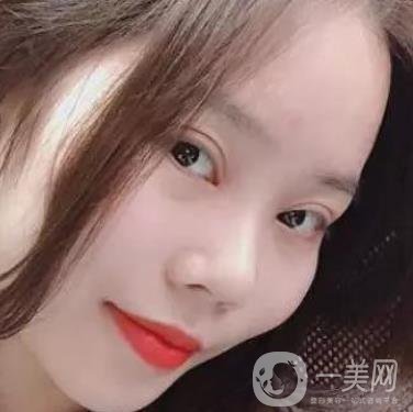淮安第一人民醫(yī)院割雙眼皮怎樣?真人案例及整形價(jià)格表分享