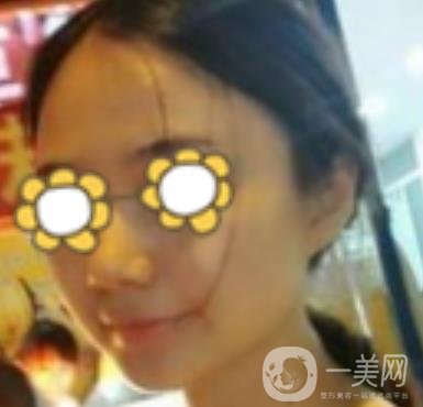 阜陽(yáng)市人民醫(yī)院整形美容科價(jià)格表2020版，附*案例