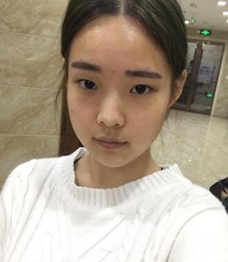 湖南第一醫(yī)院整形科價(jià)格表，附雙眼皮案例