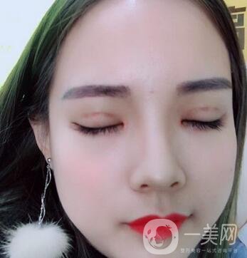 湖南第一醫(yī)院整形科價(jià)格表，附雙眼皮案例