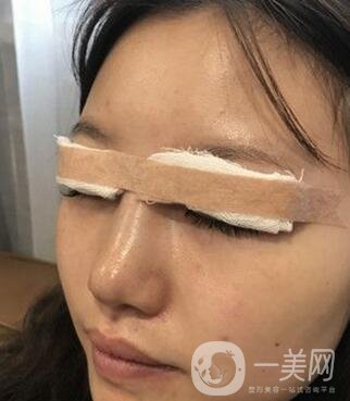 青島青醫(yī)附院整形價格表，還有雙眼皮實例