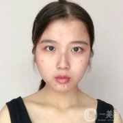 廣東省人民醫(yī)院整形科鄺石峰醫(yī)生脂肪填充案例_價(jià)格收費(fèi)表一覽