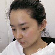 上海九院丁偉醫(yī)生隆鼻咋樣？收費貴嗎？看價格收費表&案例深入了解