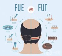 大麥微針和碧蓮盛信息介紹？植發(fā)選哪一家性價(jià)比高？