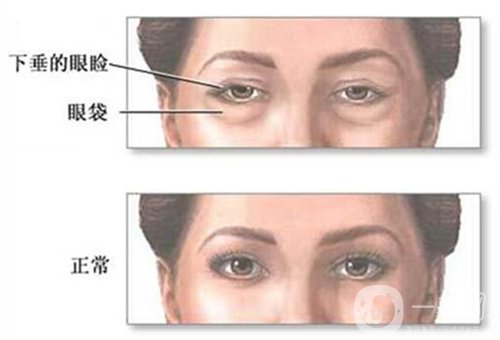 天津醫(yī)科大學(xué)眼科醫(yī)院做眼袋*果如何?價格價目表2020年全新公布