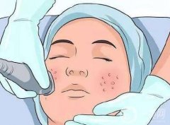 祛痘手術(shù)有哪些？