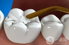 補(bǔ)牙是不是*性的？可以維持多久？