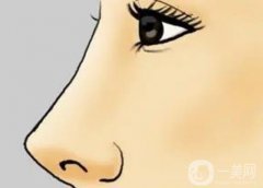 隆鼻后可以運(yùn)動(dòng)嗎？隆鼻后怎么？