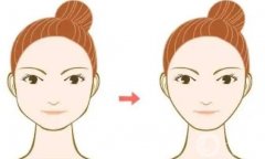 下頜角做截骨術(shù)要戴頭套的原因是什么？