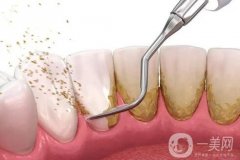 洗牙后牙齦出血怎么辦？洗完牙應(yīng)該怎么護(hù)理？