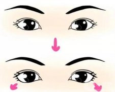 下眼瞼手術(shù)有哪些風(fēng)險(xiǎn)？