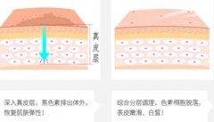 像素激光和點陣激光的不同之處是什么？