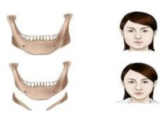 下頜角整形是削骨嗎，下頜角整形意味著什么？