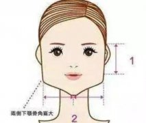 下頜角截骨術(shù)完全恢復需要多長時間？