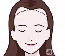脫發(fā)際線產(chǎn)生的副作用如何避免？