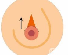 乳暈手術(shù)的特點是什么?需要注意哪些事項？