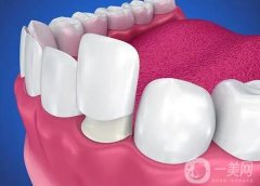 做了烤瓷牙可以做核磁共振嗎？