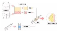 自體脂肪和脂肪膠的區(qū)別是什么？