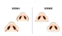 怎么避免鼻翼縮小的后遺癥？
