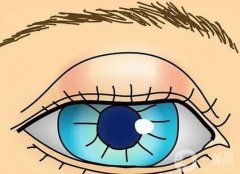 眼皮抽脂后怎么護理？