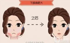 適合磨骨瘦臉的人群有哪些？