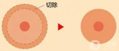 乳暈縮小手術(shù)對身體影響大不大？