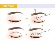 雙眼皮失敗的癥狀有哪些？