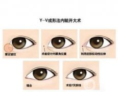 開(kāi)眼角的疤痕怎么才能快速消失？開(kāi)眼角疤痕多久能消除？