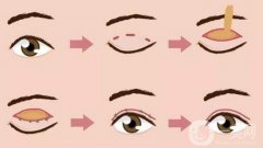 做雙眼皮需要多長時間才能恢復？