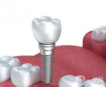 種植牙有哪些優(yōu)缺點？種植牙有哪些危害？