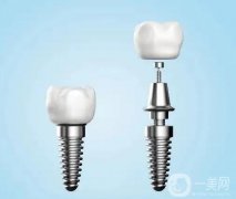 種植牙能使用多久與哪些因素有關(guān)？