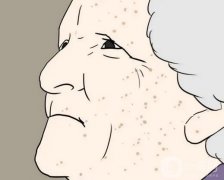 激光去老年斑多少錢？