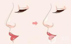 自體軟骨隆鼻有哪些后遺癥？