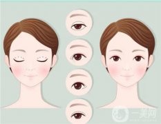 怎么把單眼皮變成雙眼皮？