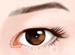 開眼角后會有疤痕增生嗎？出現(xiàn)疤痕增生怎么辦？