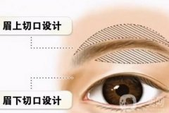 切眉失敗怎么辦，切眉可以做兩次嗎？