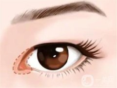 開眼角是否會導致疤痕？開眼角有哪些危害？