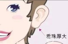 有哪些豐耳垂的方法？注射玻尿酸豐耳垂有什么注意事項?