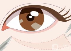 超聲波去眼袋有嗎？超聲波去眼袋有什么副作用？