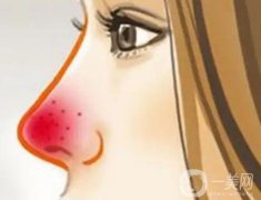 激光怎么調(diào)節(jié)酒渣鼻