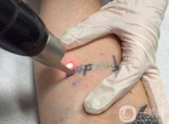 激光洗紋身會起泡的原因是什么