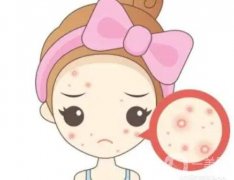 激光祛痘步驟,激光痘印的風險有多大？