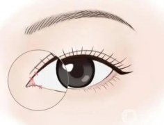 開(kāi)眼角之后抽煙有哪些危害呢？