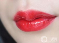 微笑唇部手術(shù)后需要幾天拆線？