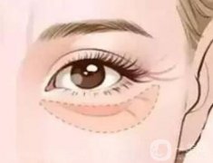 填充眼窩后恢復(fù)正常需要多長時間，流程是怎么樣的